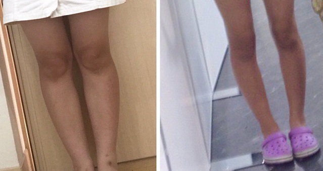 【衝撃画像】ここまで美脚に!リンパマッサージを1年半続けた実証写真にネット騒然